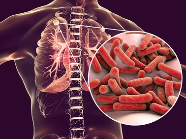 Tuberculosis
